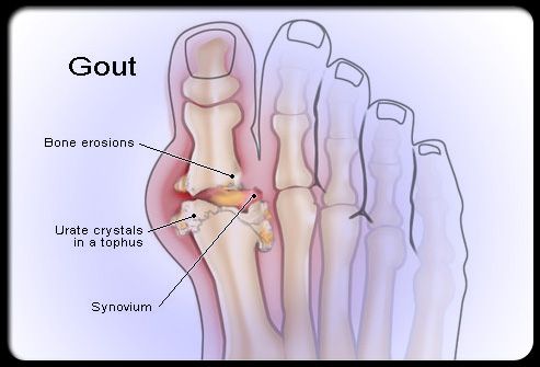 Gout