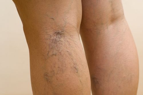Paano Makayanan ang Deep Vein Thrombosis