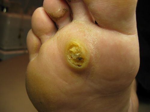 Ang sanhi ng warts sa mga binti