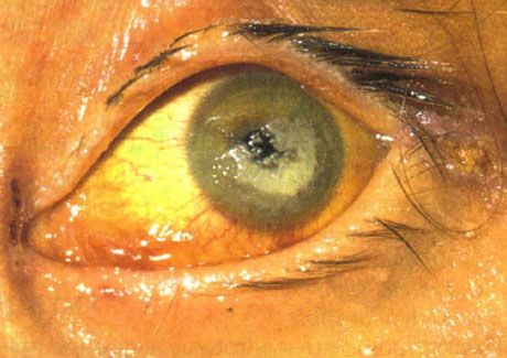 Bilateral keratitis na dulot ni Candida sa isang batang may malubhang immunodeficiency