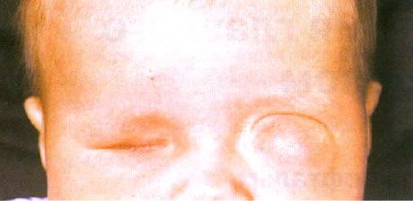 Microphthalmos na may nauugnay na pagbuo ng cyst (kaliwang mata). Anophthalmos (kanang mata).