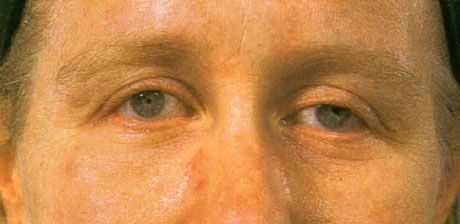 Bilateral microphthalmos na walang nauugnay na mga colobomas, sa pagtanda