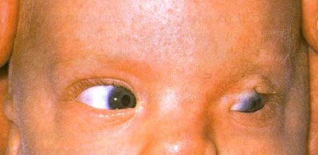 Fraser syndrome. Hindi kumpletong cryptophthalmos ng kaliwang mata.