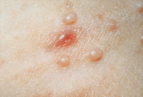Molluscum contagiosum: larawan