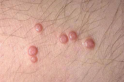 Molluscum contagiosum: larawan