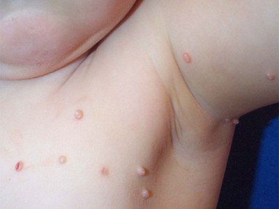 Larawan ng molluscum contagiosum