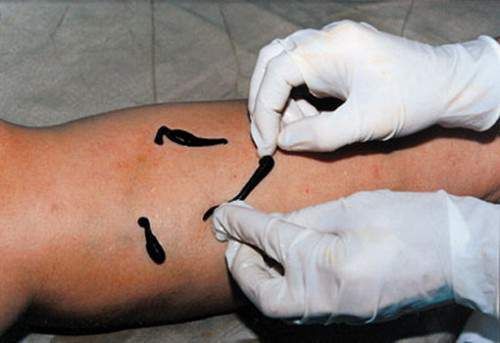 Mga linta laban sa varicose veins