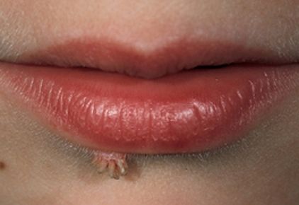 Mga warts na tulad ng thread