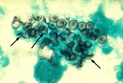 Ang causative agent ng pneumocystis (Pneumocystis jiroveci)