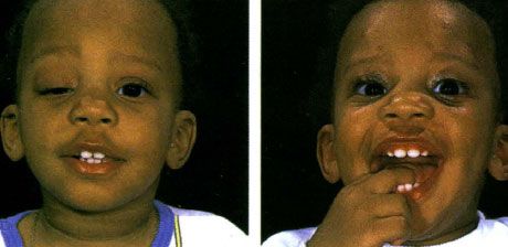 Malubhang unilateral ptosis na may kawalan ng itaas na eyelid fold sa kanang mata.