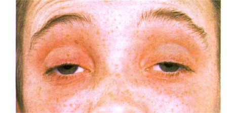 Panlabas na ophthalmoplegia. Bilateral ptosis. Binubuksan ng pasyente ang mga mata sa pamamagitan ng pagtaas ng kilay.