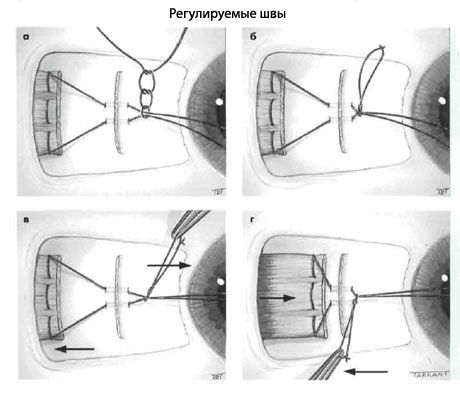 Strabismus - Operasyon