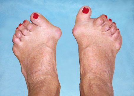 Bakit nangyayari ang rheumatoid arthritis?