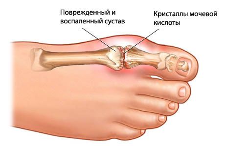 Subacute stage of gout manifestations