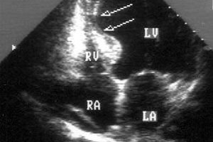 Myocardial Akinesia Mga Sanhi Sintomas Diyagnosis Paggamot Mahusay Na Tungkol Sa Kalusugan Sa Ilive