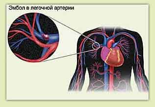 Ang pulmonary embolism at mga dibdib ng dibdib sa kaliwa