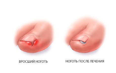 Ingrown toenail