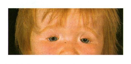 Bilateral coloboma ng eyelids sa isang bata na may Goldenar syndrome. Hindi pagsasara ng palpebral fissure sa kaliwa