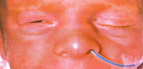 Congenital entropion (inversion).